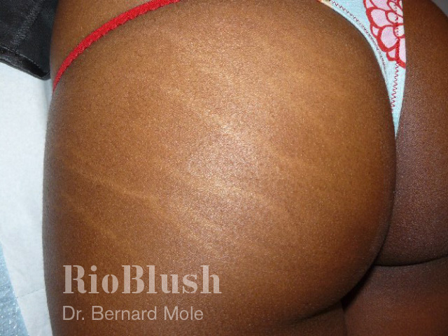 Stretch marks before